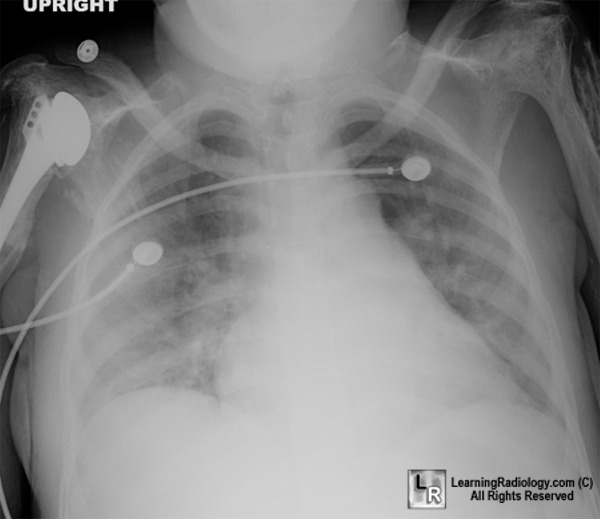  Acute Chest Syndrome; Dislocated shoulder; Congestive heart failure