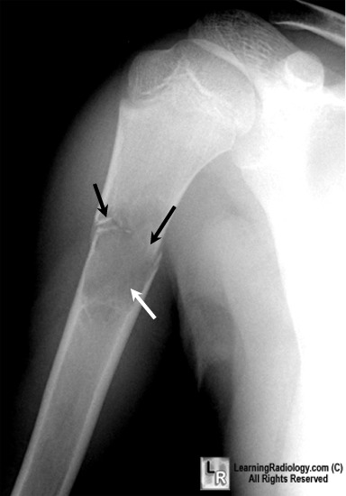 aneurysmal bone cyst mandible. .com - unicameral, one, cyst,