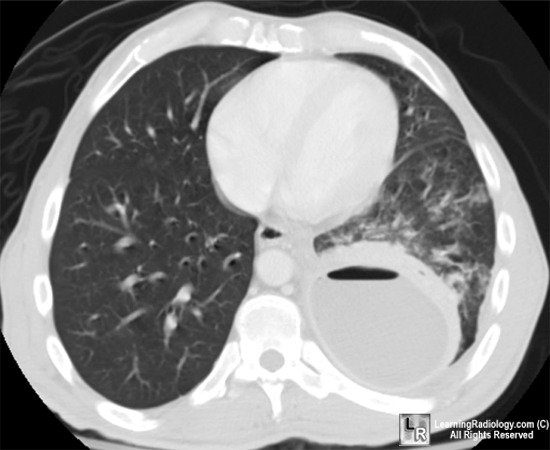 Hiatal Hernia Cxr