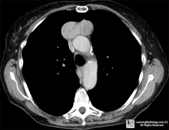 Normal; TB; Pulmonary Laceration; Thymoma; Dissecting Aortic Aneurysm