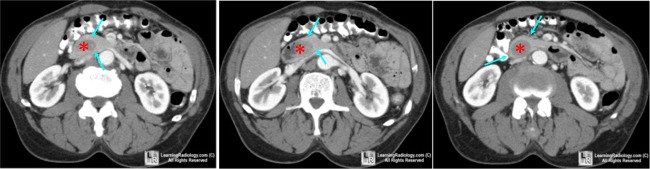 Annular Pancreas