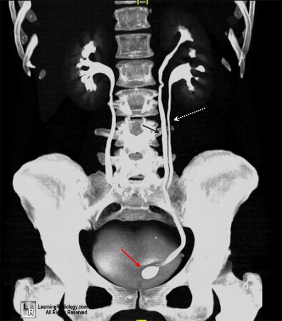  ectopic, duplicate, duplex, kidney, collecting, system, ureter, bladder, 