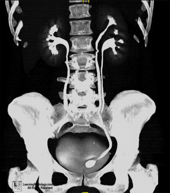 duplex kidney pose