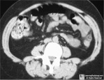 epiploic appendagitis