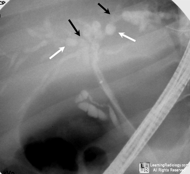 Sclerosing Cholangitis