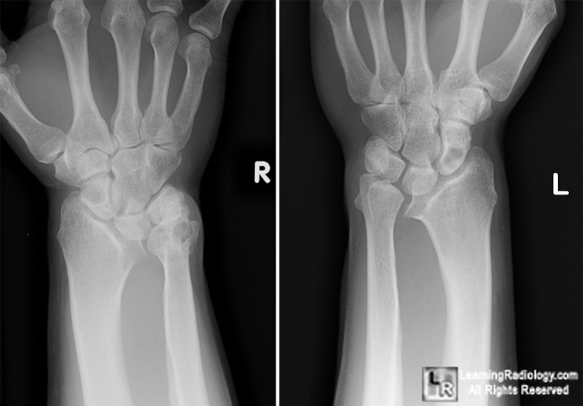 barton fracture wrist