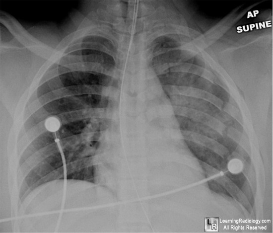 CXR