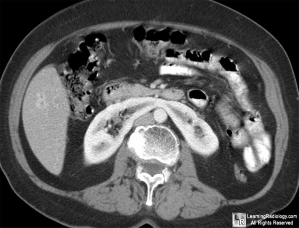 Aortic aneurysm; Horseshoe kidney; Retrocaval ureter; Shock bowel 