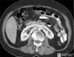 Horseshoe Kidney