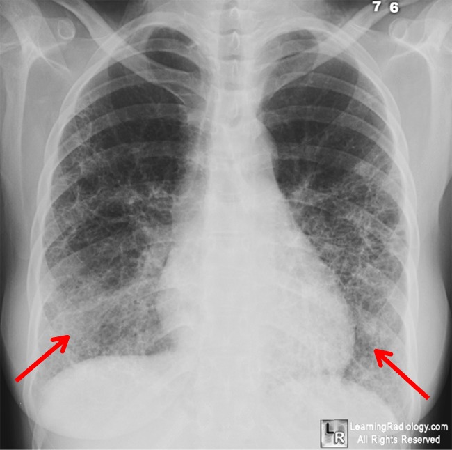 Scleroderma