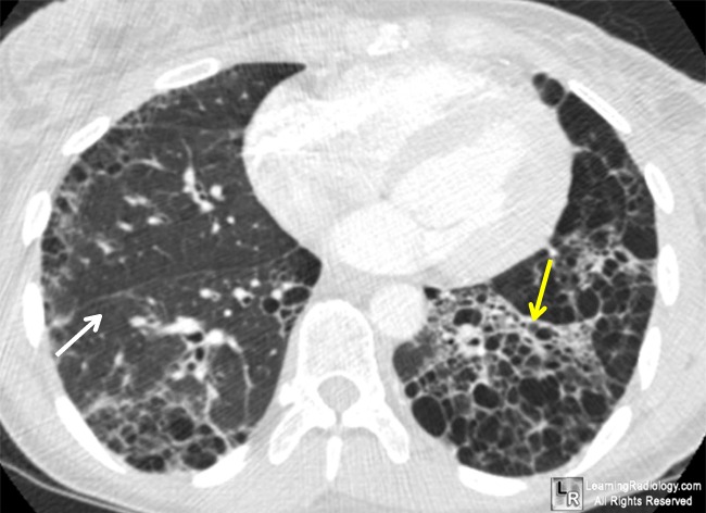 Scleroderma