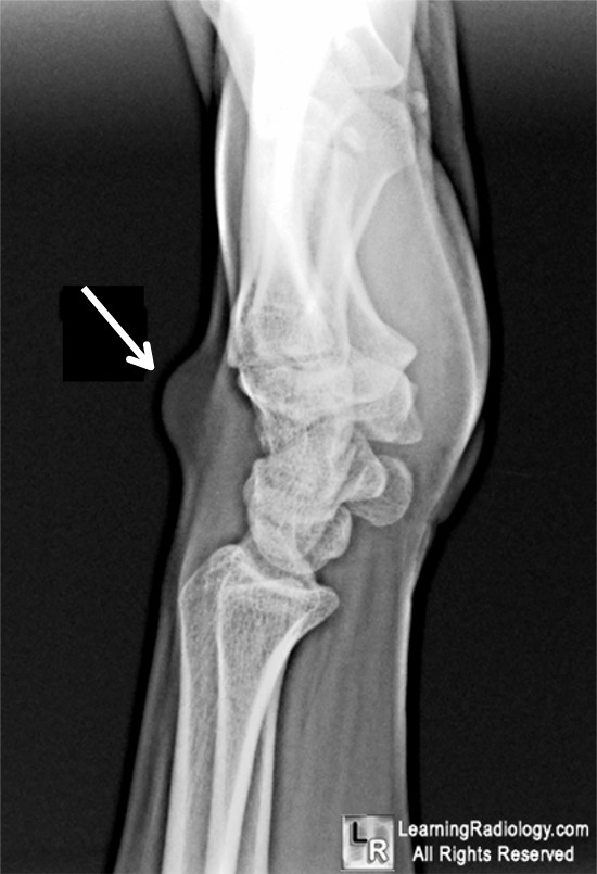 Ganglion Cyst