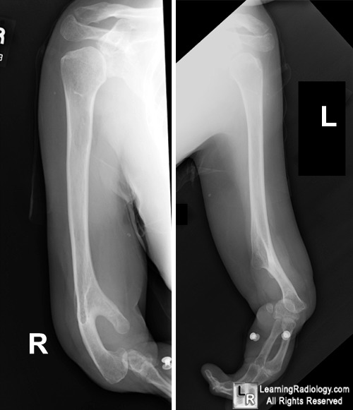 Shoulder dislocations; Thalidomide-induced phocomelia; Holt-Oram Syndrome 