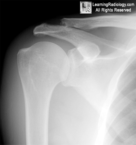 Posterior shoulder dislocation