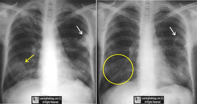 Wegener's Granulomatosis