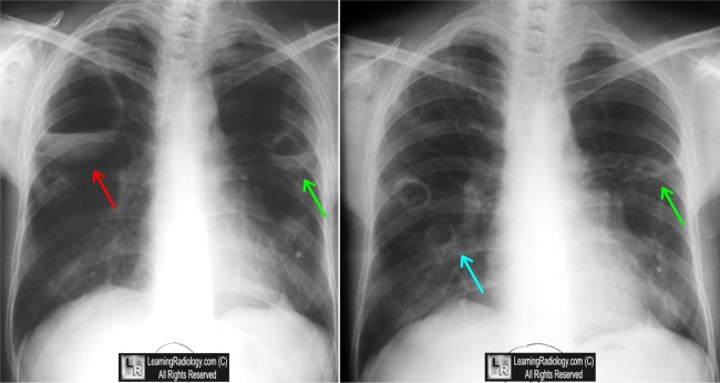 Wegener's Granulomatosis