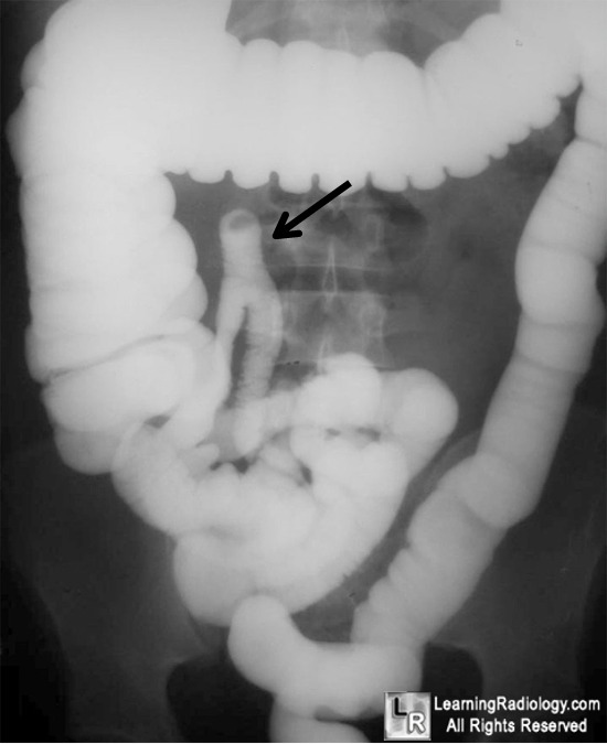 meckel's diverticulitis ct radiology