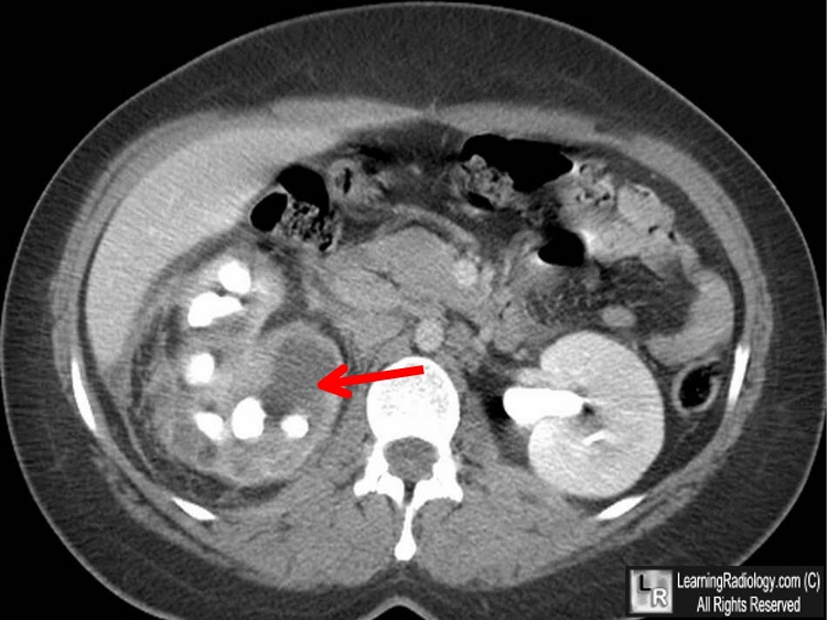 pyelonephritis xanthogranulomatous ct scan abdomen kidney renal infection contrast radiology enhanced scans ray imaging learningradiology without pre axial prognosis death