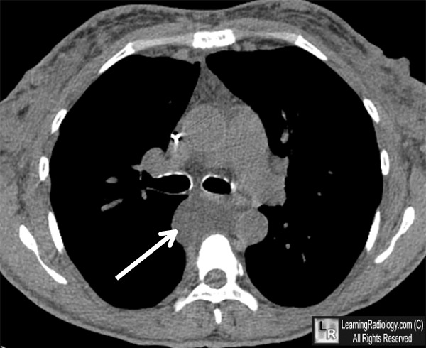 mediastinal duplication cyst ct