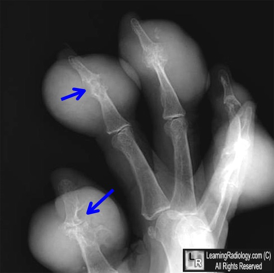 Gout. There are large tophaceous deposits (white arrows) surrounding ...