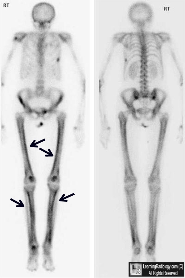hypertrophic osteoarthropathy