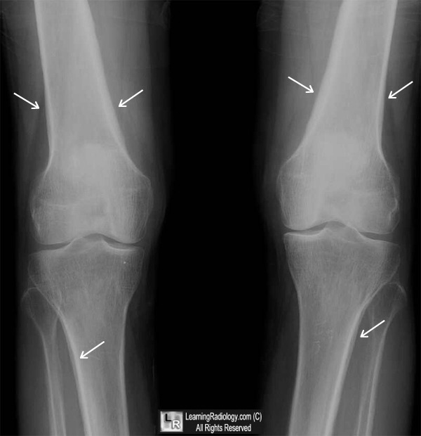 hypertrophic osteoarthropathy