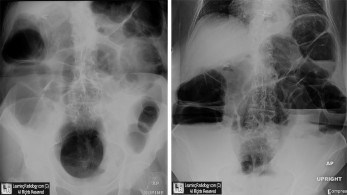 ogilvie syndrome