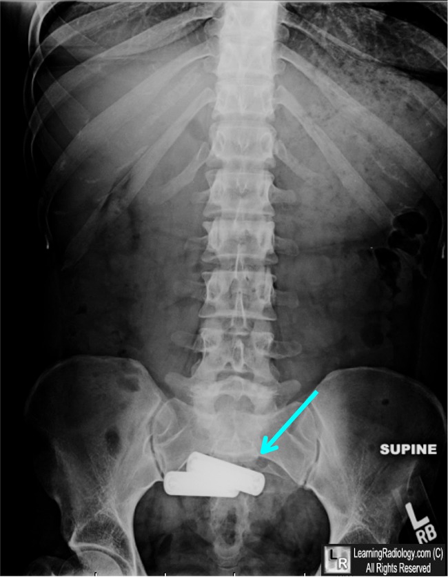 Battery Ingestion. In radiograph of the abdomen on the left, AA ...
