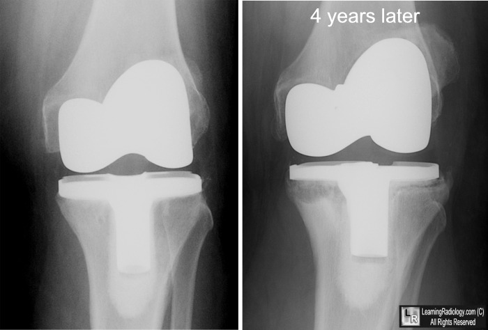 knee replacement prothesis Discover the variety of knee replacement options available from depuy synthes companies designed to help you recover quickly & get back to everyday life. knee replacement prothesis Discover the variety of knee replacement options available from depuy synthes companies designed to help you recover quickly & get back to everyday life.