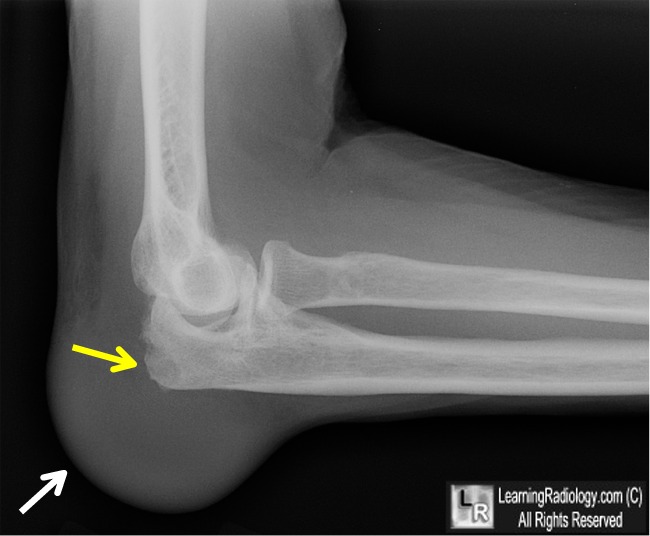 Olecranon bursitis gout elbow