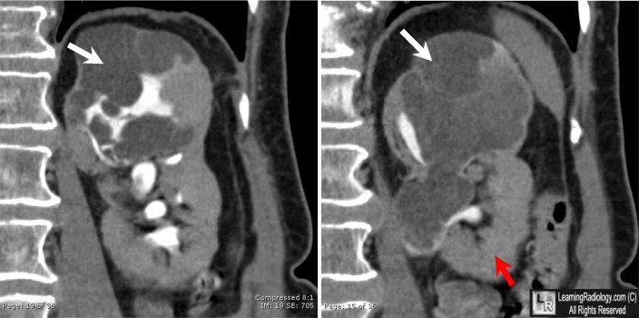 Cystic nephroma