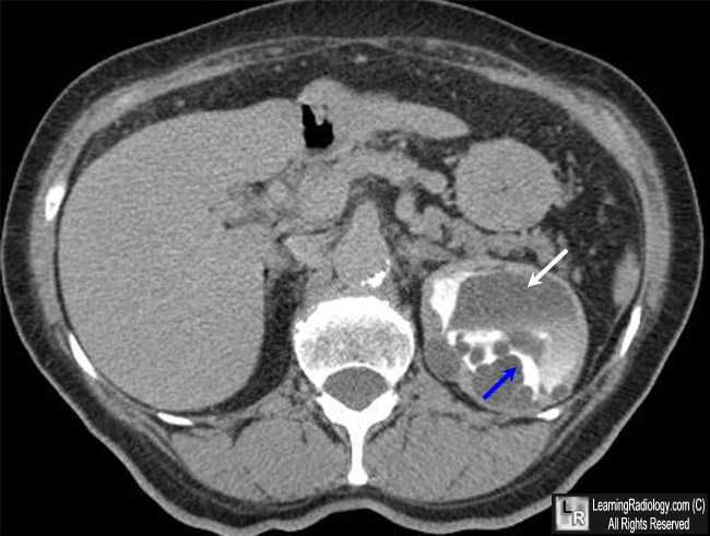 Cystic nephroma