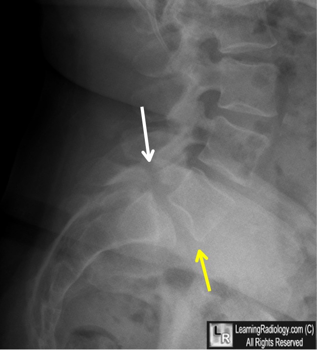 retrolisthesis and emedicine Spondylolisthesis can be a painful condition affecting the back caused by a vertebrae from the lower spine slipping out of position. retrolisthesis and emedicine Spondylolisthesis can be a painful condition affecting the back caused by a vertebrae from the lower spine slipping out of position.