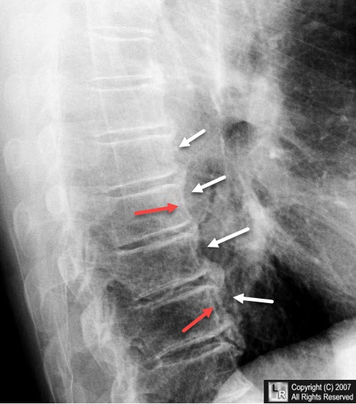 Diffuse Idiopathic Skeletal Hyperostosis (DISH)