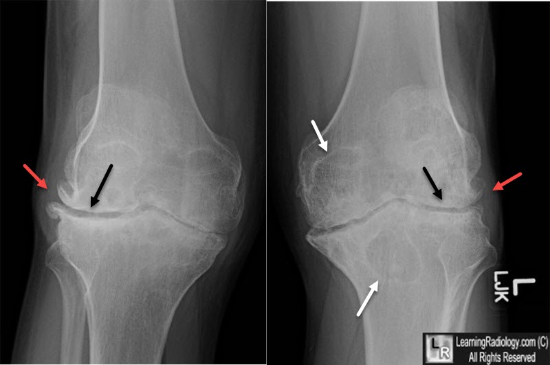 Hemophiliac Arthritis