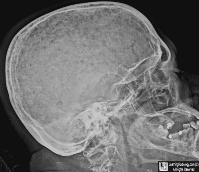 LearningRadiology - Multiple Myeloma