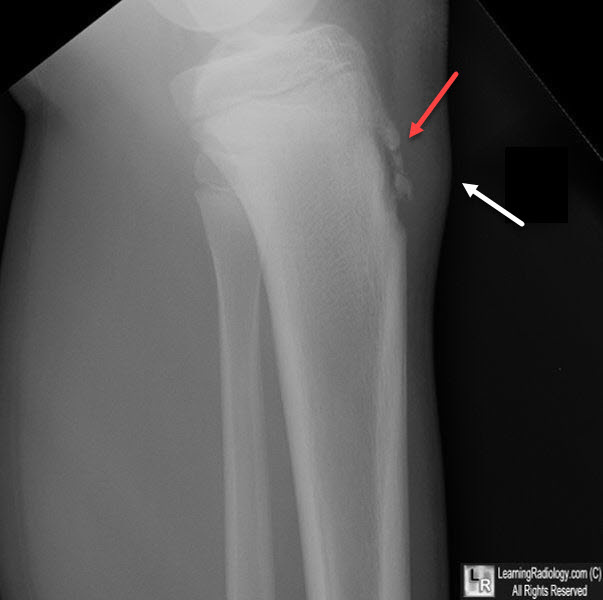 Osgood-Schlatter Disease