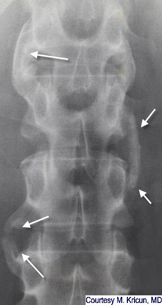 psoriatic spondylitis