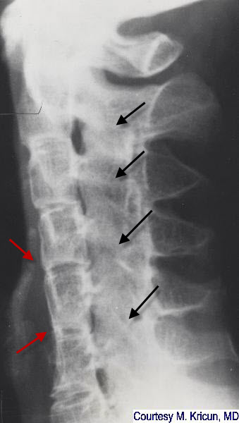 rheumatoid arthritis, spine