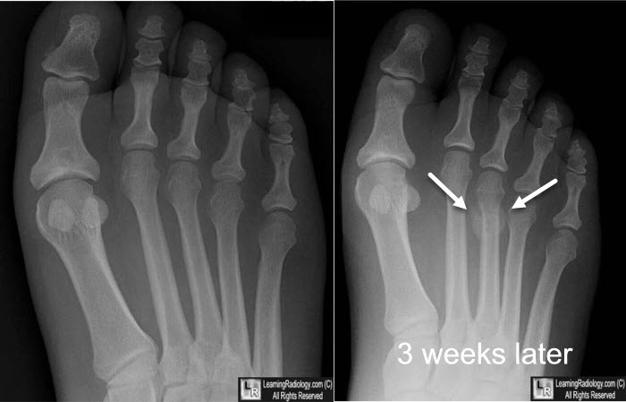 Stress fracture of the 3rd metatarsal