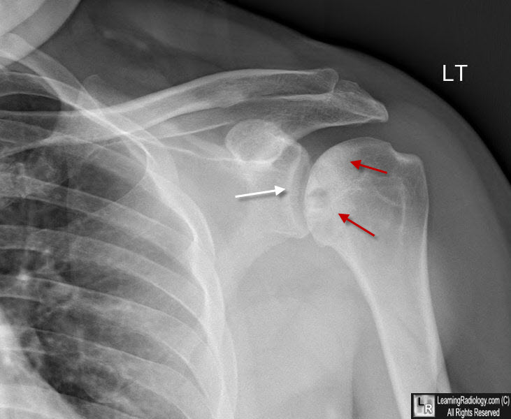 Avascular Necrosis of the Humeral Head