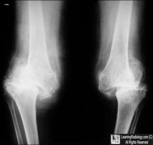 Charcot joint