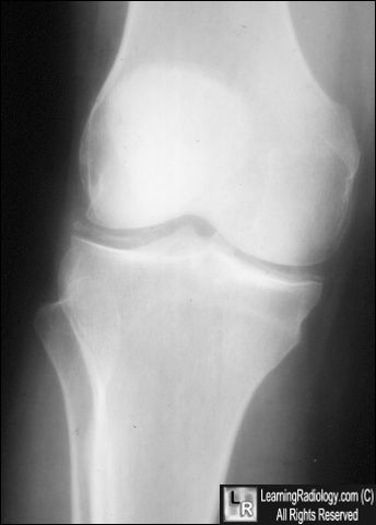 Chondrocalcinosis