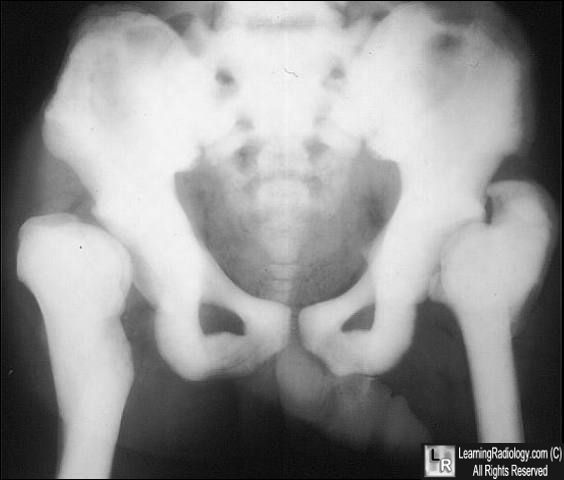 Osteopetrosis