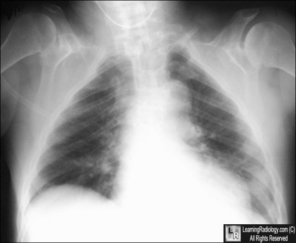 Cleidocranial Dysostosis