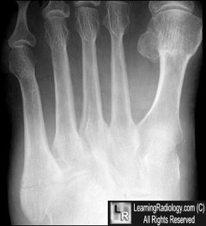 Jones Fracture