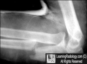 Monteggia fracture-disclocation