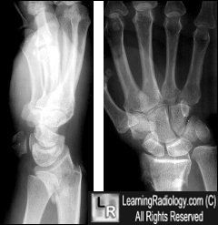 Smith's Fracture