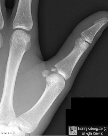 hand sesamoid bone