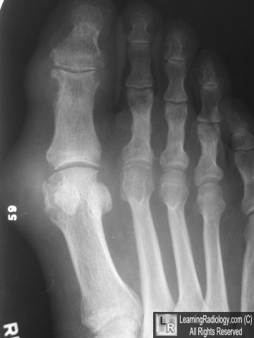 Gout foot Gout foot